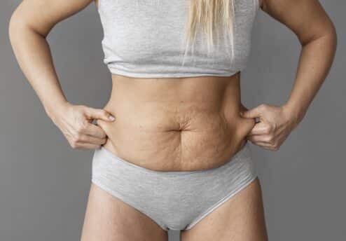 Abdominoplastyka x